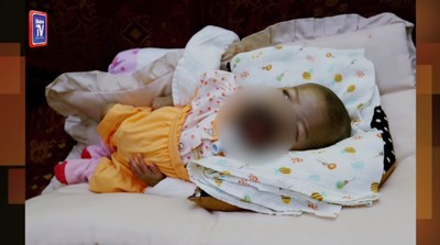 3個月大就化療！大馬女嬰「生殖細胞長嘴上」　腫瘤越來越大…將赴英治療