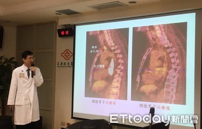 影／高粱酒當水喝20年　他喉嚨卡卡數週揪出「三期食道癌」