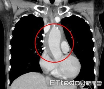 撕裂胸痛慘「升主動脈壁內血腫」　醫揭7大症狀...48小時內恐奪命