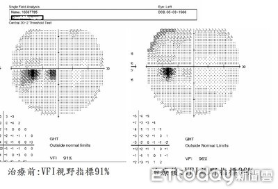 中醫治療「逆轉」虹彩炎 視野提高到96％