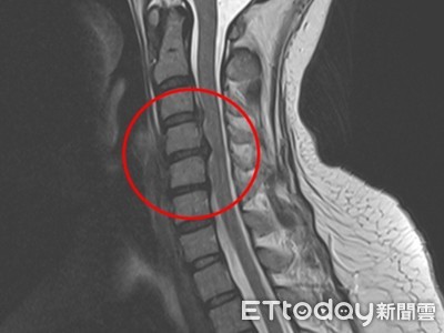 胸口悶痛小心頸椎間盤破裂 　頸椎間盤切除及融合手術解困擾