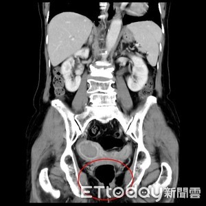 台中7旬婦停經20年…私密處卻出血　竟是罕見「雙子宮併子宮內膜癌」