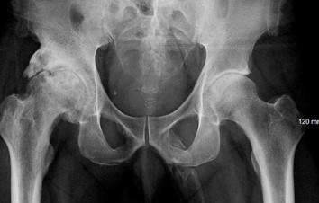 老翁跌倒下體傳出陣痛…　就醫才發現「生殖器骨化」整根硬掉變白骨