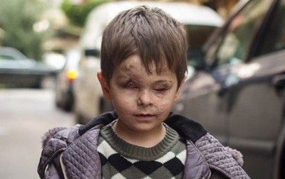 戰火下的犧牲品！逃難遇空襲…窗戶在眼前震碎　4歲童毀容「再也看不見」