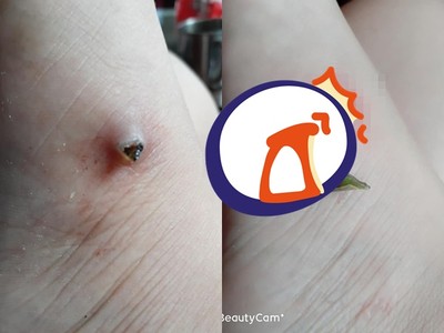 右腳爆痛1個月！她緩慢「擠出酒瓶碎片」全都錄　網發麻：好大一塊