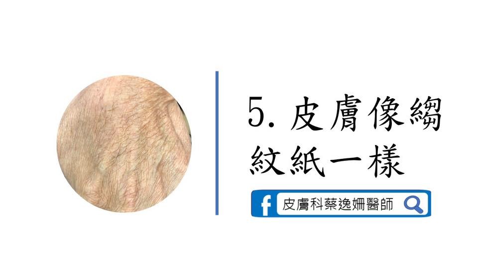 青筋超明顯！8大跡象＝「你的手老了」。（圖／截自蔡逸姍醫師臉書）