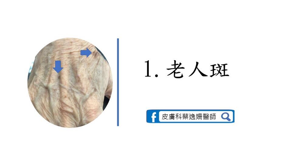 青筋超明顯！8大跡象＝「你的手老了」。（圖／截自蔡逸姍醫師臉書）