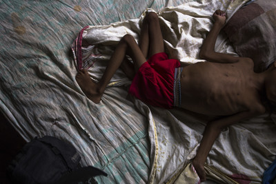 全球2億孩童過胖或過瘦 　隱性飢餓成最大隱憂