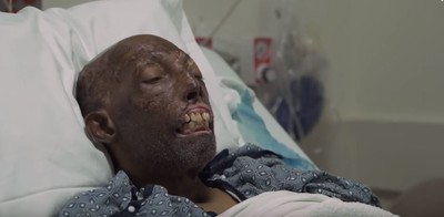 68歲阿伯車禍毀容拒絕白皮膚　等6年「臉部移植」成功變臉
