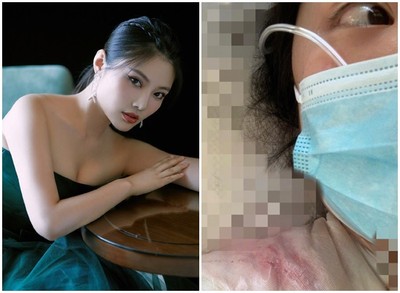 第一美胸脖子長出「粉色大肉球」! 挖掉險喪命 ... 「整片爆出血紫色」傷照曝