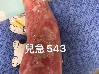 熱水袋「溫膚」竟燙傷！男童腳「狂冒水泡」醫心疼：這體質母湯