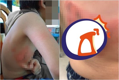猜拳輸了潑冷水！同學偷裝「102度滾燙熱水」…10歲童右胸慘長超大水泡