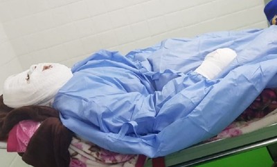 睡夢中被丈夫淋滾燙熱油！　人妻嚴重毀容「失明也無法說話」