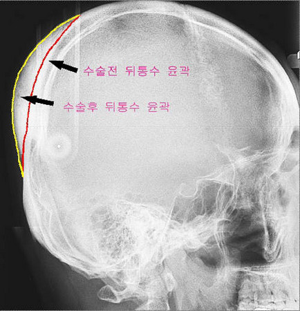 韩国「后脑勺整形手术」 现在还有什麼不能整呢
