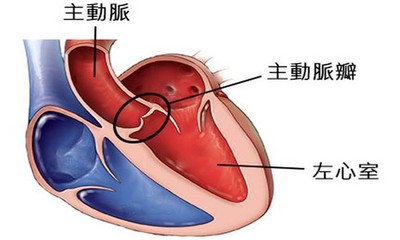 劉真裝葉克膜搶救 醫解析「主動脈瓣膜狹窄」危險性...手術分3種