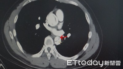 健身房閉氣挺舉　高血壓男GG了！「主動脈剝離」連夜手術14hr救回一命