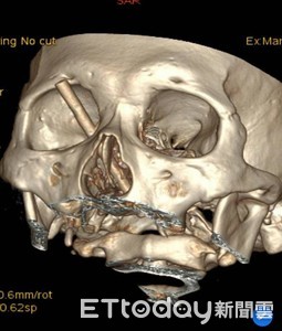 真命大！右眼窩被8公分筷子插入　黑道兄弟術後視力還有1.0