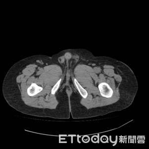 男腹痛就醫驚見罹癌　蛋蛋亂跑！造精能力變差「癌化率飆10倍」