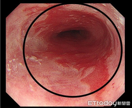 檢查竟是罕見食道腺癌前病變合併分化不良