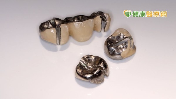 ▲移除下來的汞牙（牙醫診所提供）。（圖／健康醫療網）