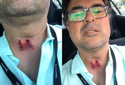 記者採訪示威者喉嚨遭「橡膠子彈直射」　深紅色傷痕手指一摸都血
