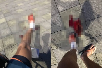 脫鞋子海邊玩水！男大生突遭「爆痛夾刺」鮮血狂噴…網看完嚇壞：小心截肢