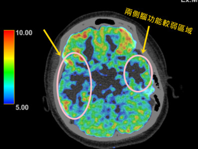 一天癲癇30次無法正常學習吃飯、走路　流感重症葉克膜搶命竟找出病因