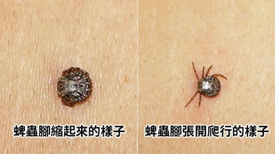 艾薇兒、小賈斯汀都得過萊姆病！　戶外出遊避免蜱蟲叮咬這樣做