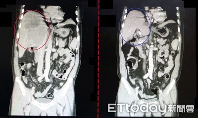 嗜酒男肝癌晚期「2次肝動脈化療」　14公分肝腫瘤幾乎消失