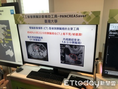 世界首創！台大成功研發「AI自動辨識胰臟癌」　準確率超過9成