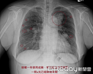 咳嗽1年吃成藥！她「咳出血絲」罹肺癌末期…崩潰：我都不抽菸