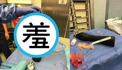 嚇到「塞」手手！　醫從男子肛門拔出「30公分黑手臂」