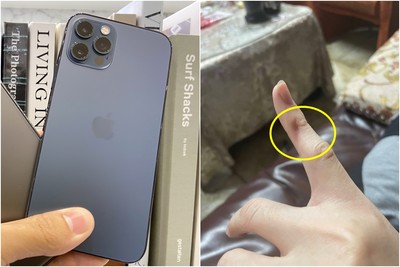 換iPhone12 pro滑了5分鐘「手指爆痛」！男看凹洞崩潰　恐怖照曝光