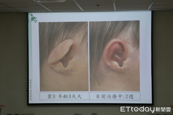 ▲▼新生兒耳朵變形經過矯正後的前後變化。（圖／門諾醫院提供，下同）