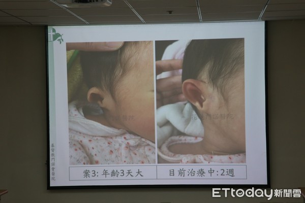 ▲▼新生兒耳朵變形經過矯正後的前後變化。（圖／門諾醫院提供，下同）