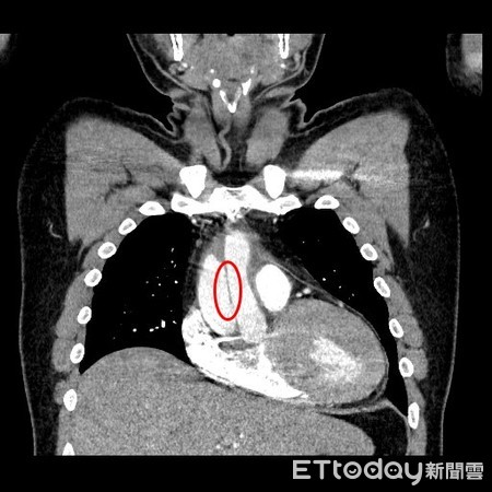 ▲35歲壯男主動脈剝離竟自行就醫，醫嚇壞：10人走著進來全躺著出去。（圖／記者游瓊華翻攝）