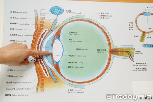 ▲侯鈞賀解釋，水晶體組織的混濁不透明就是白內障。（圖／侯鈞賀提供）