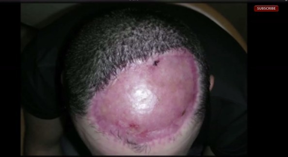 割肿瘤导致前额全秃 英男头皮「植入气球」成功生发