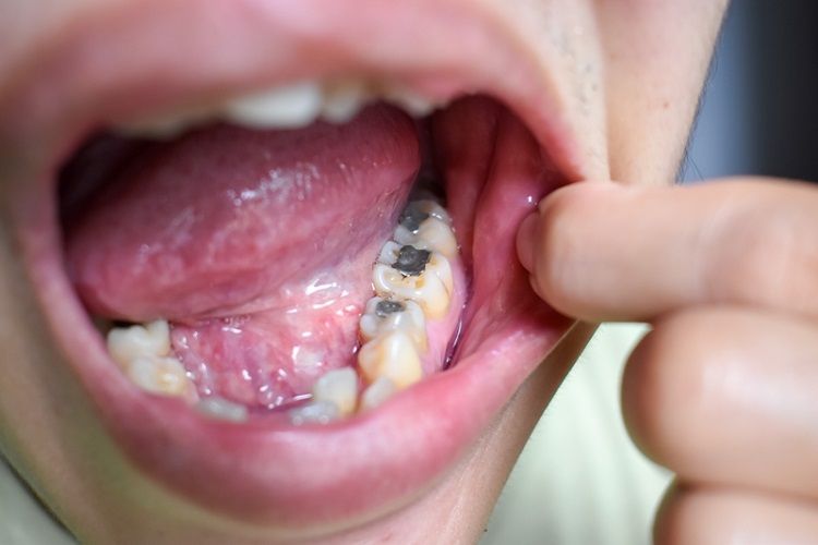吃冰牙齒就痠軟！醫示警「5大原因」讓牙齒超敏感  減重、橫向刷牙都中