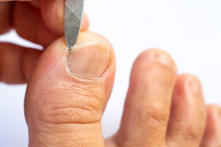 指甲剪圓弧形錯了！「正確剪法」多數人不知道  醫示警「5幫兇」害指甲嵌肉裡