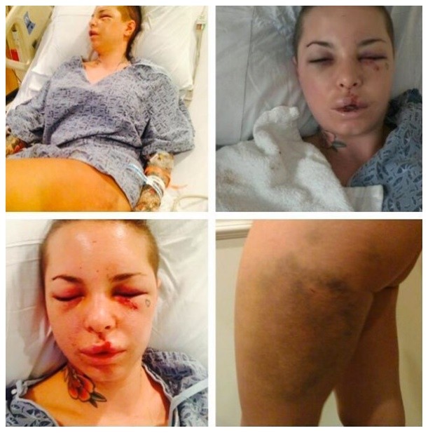 av女优被格斗手男友狠k脸全毁 募款300万重建美艳外表