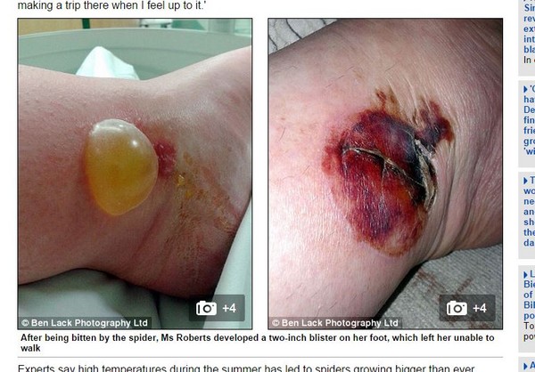 脓泡(左)就像半颗乒乓球浮在脚踝,而事后皮肤也留下了相当大的伤口