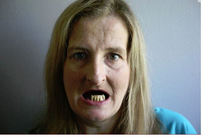 醒来发现口腔是空的! 英46岁妇试牙套牙齿竟被拔光